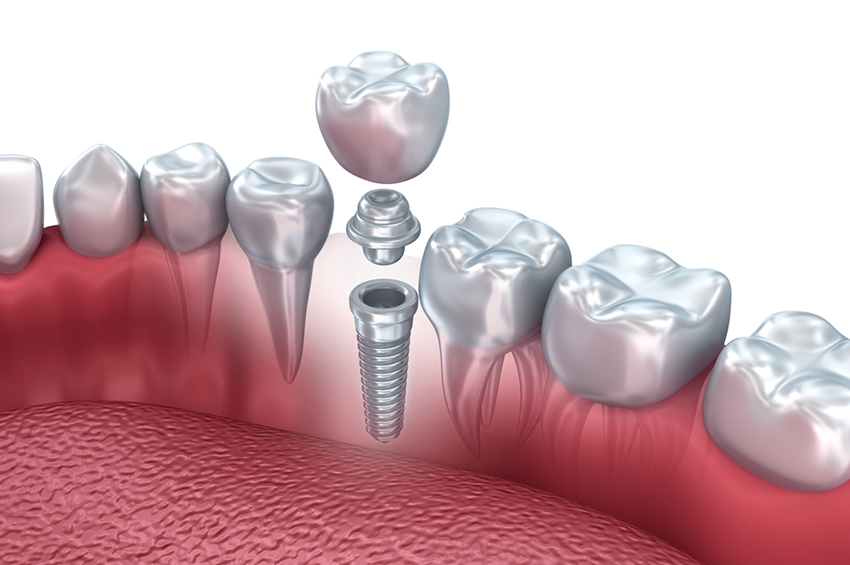 The Role of Technology in Modern Dental Implant Surgery in Delhi
